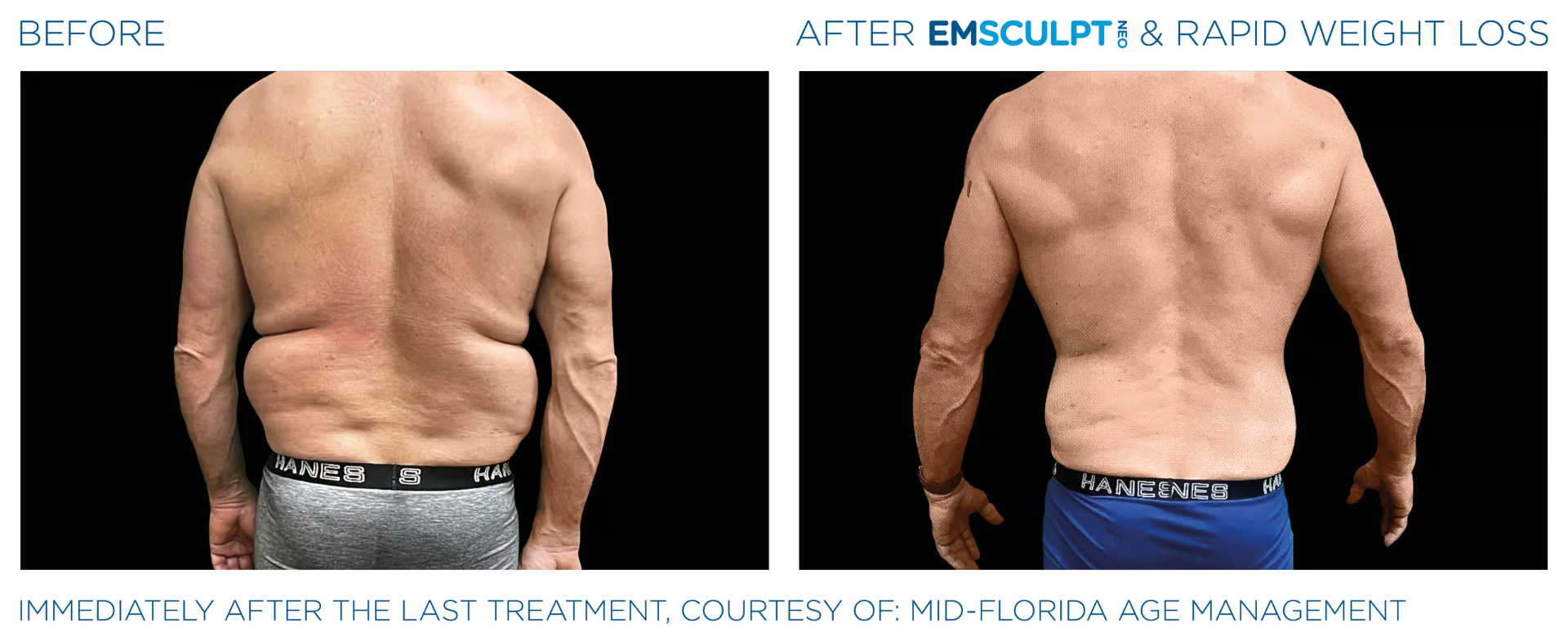 Back & Abdomen before and after results
