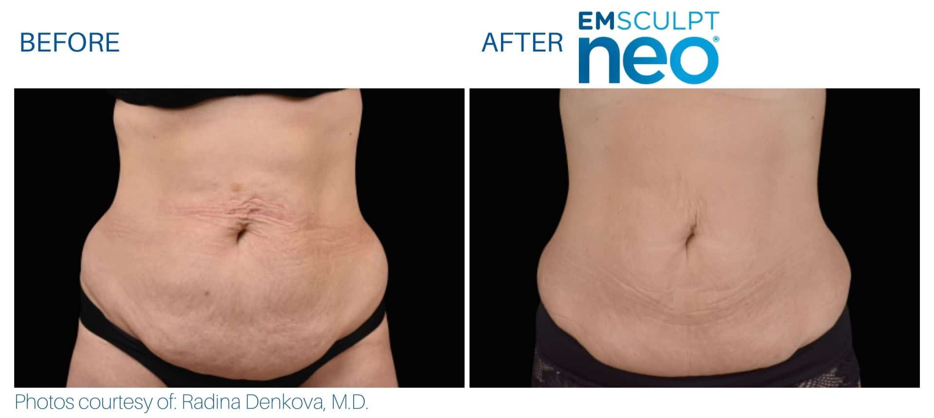 Abdomen before and after results