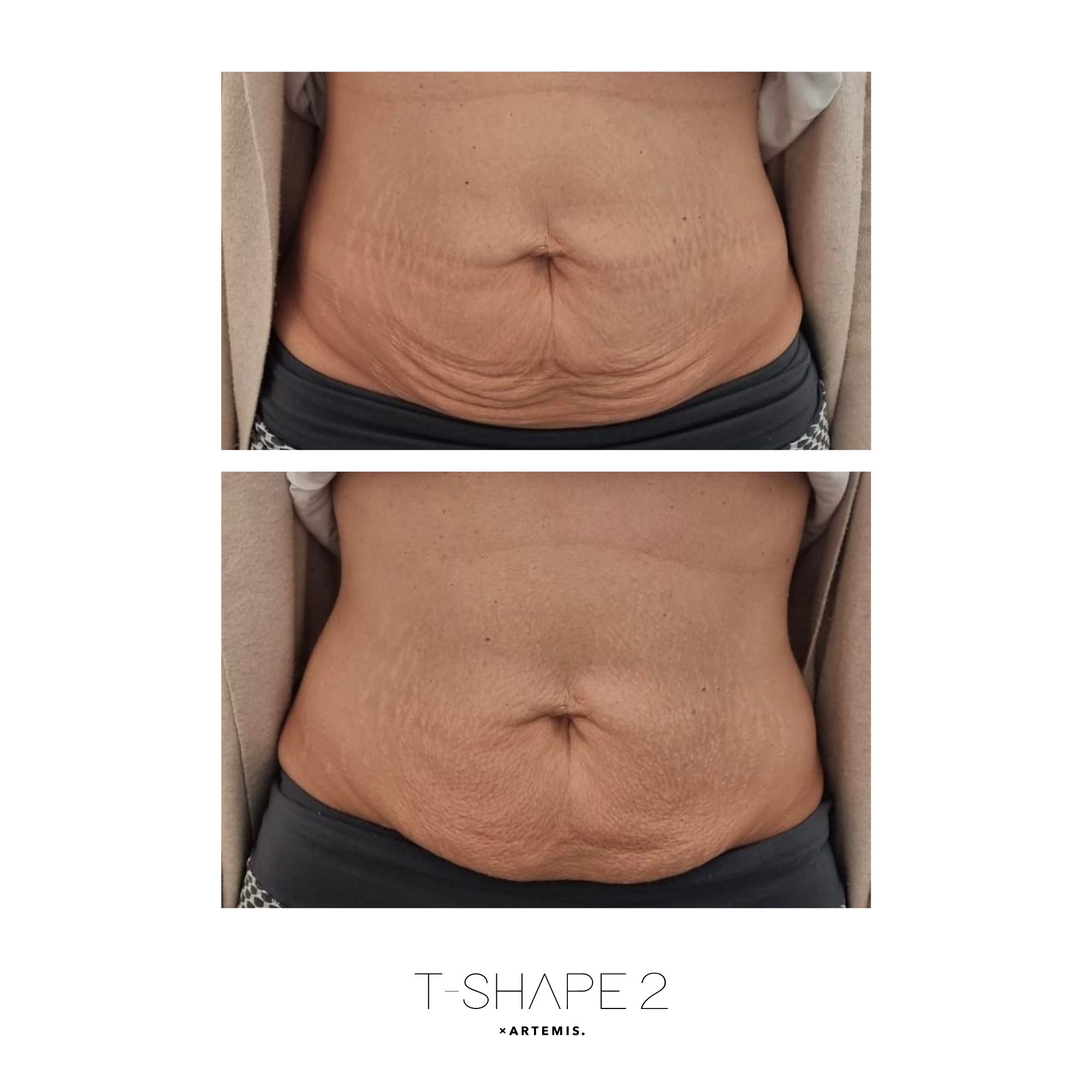 Abs before and after results