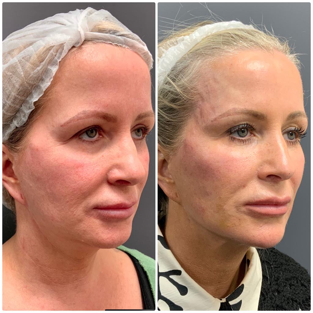 Neogen Face Lift results — Redness & Surface Texture