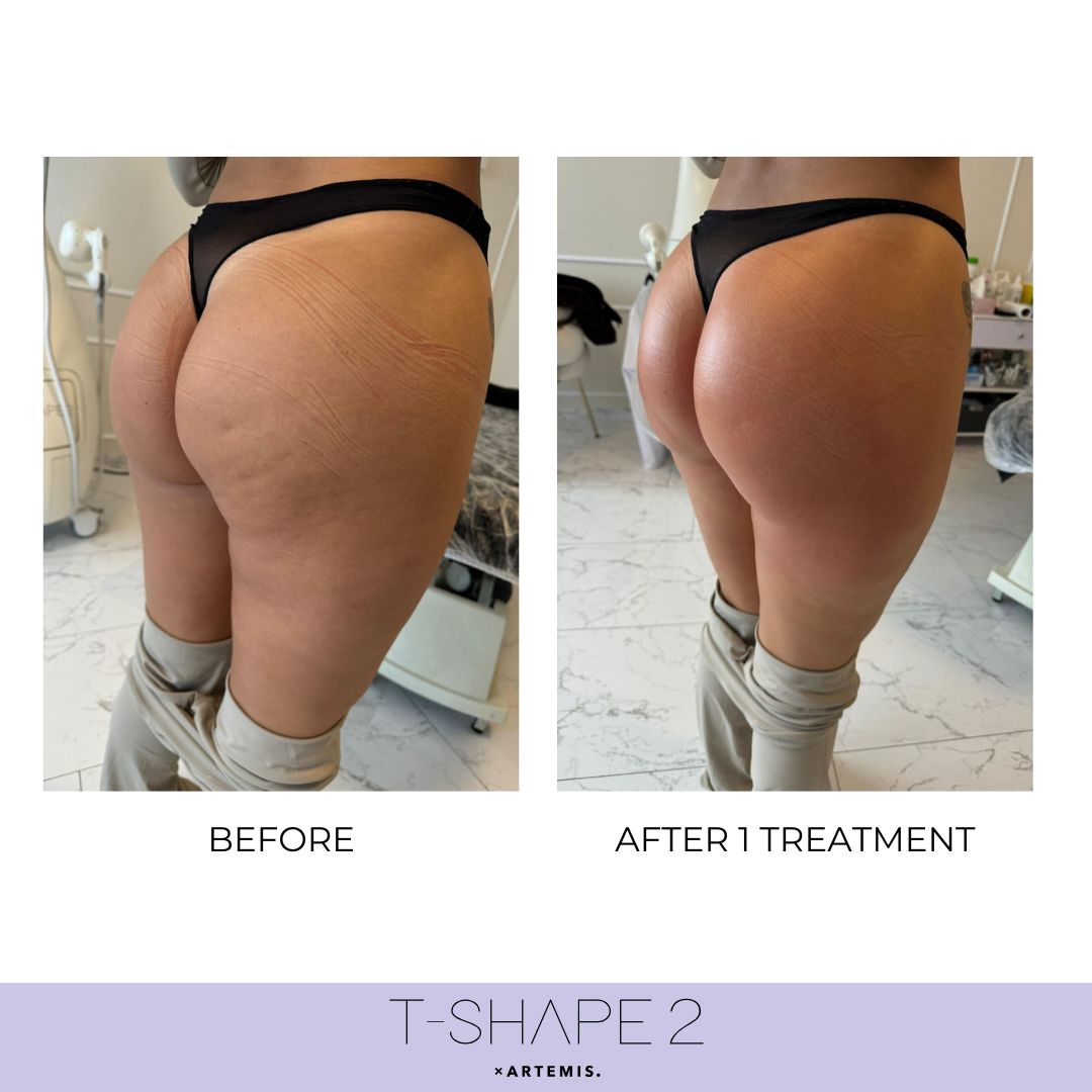 Body before and after results