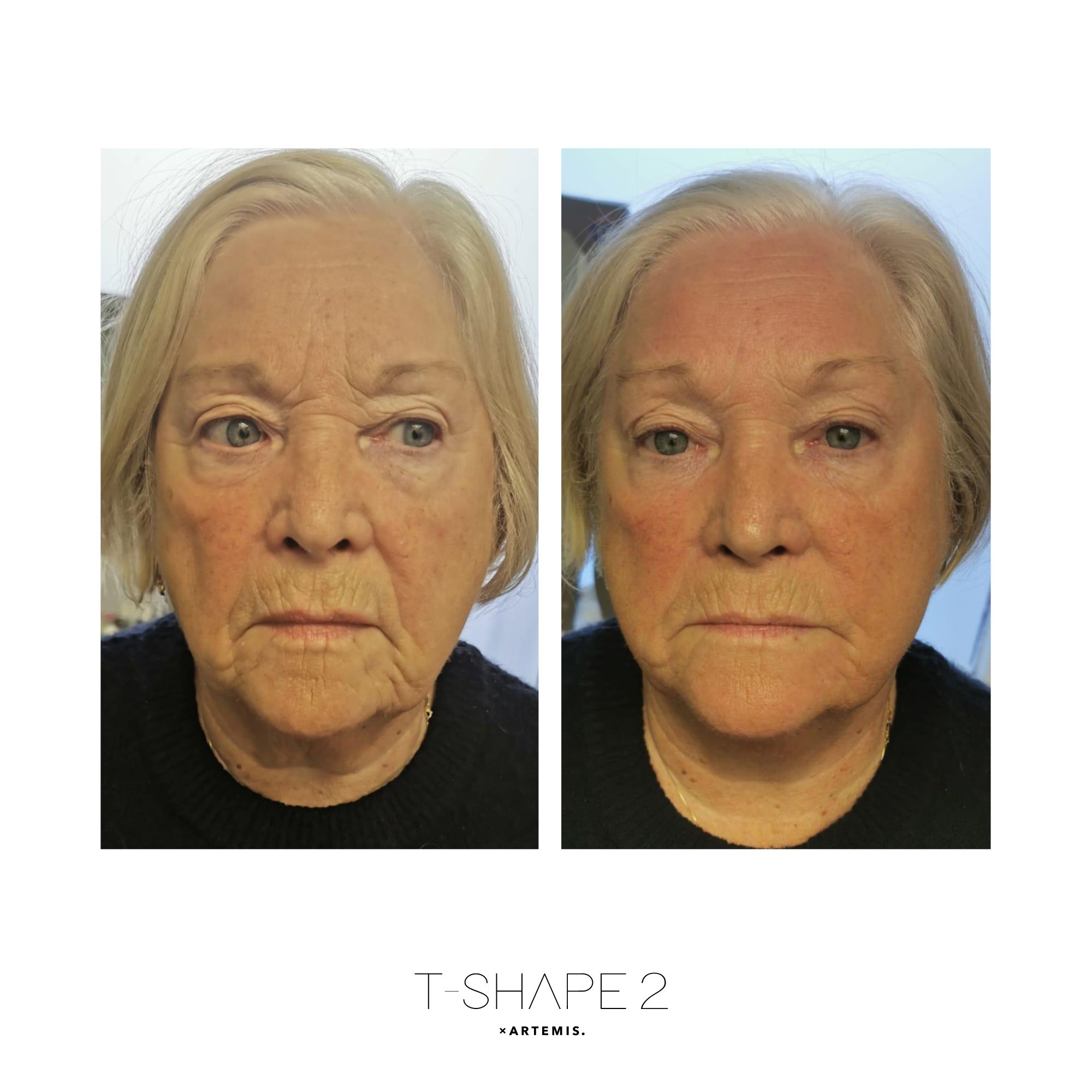 Face before and after results