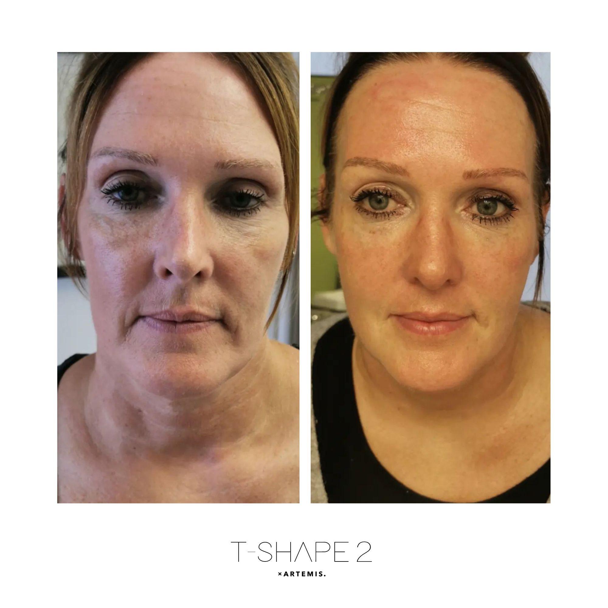 Face before and after results