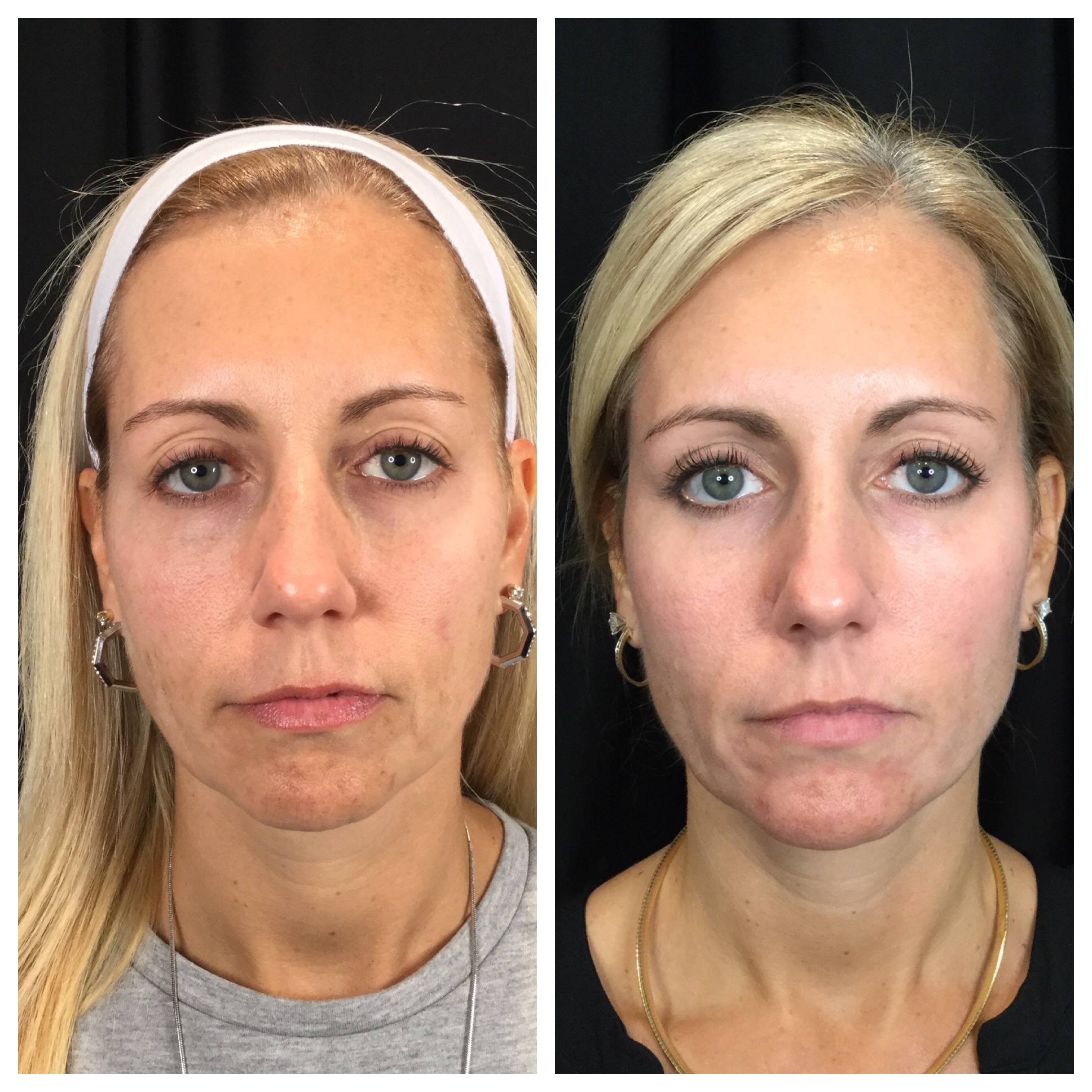 Neogen Face Lift results — Firmness & Skin Quality